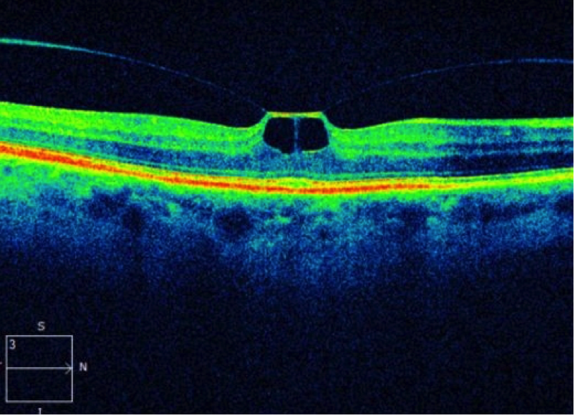 WHY OCT IS AN IMPORTANT PART OF YOUR VISIT TO THE OPHTHALMOLOGIST.