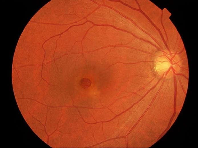 Diabetes and Vision Loss